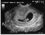 Ultrasound photo of Mason